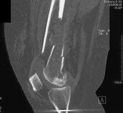 Femur Fracture - CTisus CT Scan