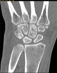 Normal Wrist - Musculoskeletal Case Studies - CTisus CT Scanning