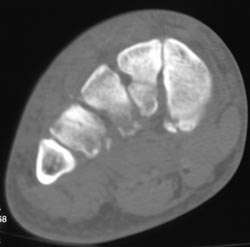 Metatarsal Fractures - CTisus CT Scan