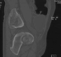 Acetabular Fracture - CTisus CT Scan