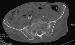 Sacral Stress Fractures - CTisus CT Scan