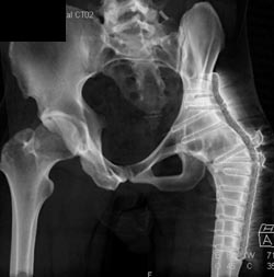 Hip Fusion in 3D - CTisus CT Scan