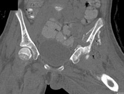 Osteomyelitis Left Hemipelvis - CTisus CT Scan