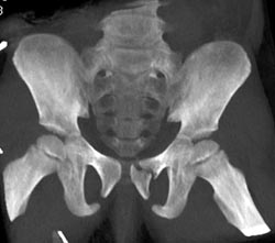 Left Symphysis Fracture - CTisus CT Scan