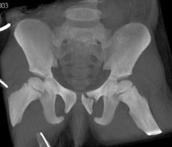 Symphysis Fracture - CTisus CT Scan