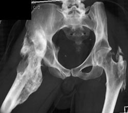 Heterotopic Ossification of the Hips - CTisus CT Scan