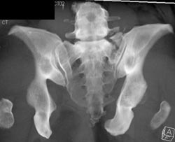 Sacral Fracture With Step Off - CTisus CT Scan