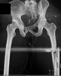 Femur Fracture in Body Cast - CTisus CT Scan