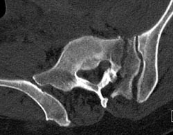 Sacral Fracture - CTisus CT Scan