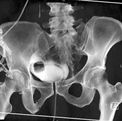 Sacral and Pelvic Ring Fractures - CTisus CT Scan