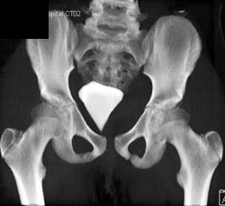 Pelvic Hematoma With Left Symphysis Fracture - CTisus CT Scan