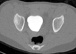 Pelvic Hematoma - CTisus CT Scan