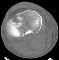 Tibial Plateau Fracture - CTisus CT Scan