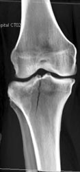 Tibial Plateau Fracture - CTisus CT Scan