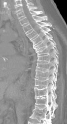 Osteoporosis With Collapsed Vertebral Bodies - Musculoskeletal Case ...