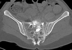 Repair of Sacral Fractures - CTisus CT Scan