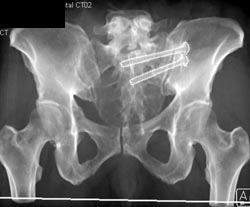 Repair of Sacral Fracture - CTisus CT Scan