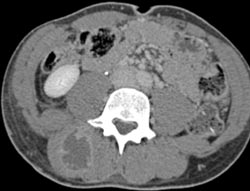 Paraspinal Muscle Abscess - CTisus CT Scan