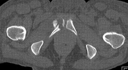 Insufficiency Fracture - CTisus CT Scan