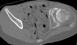 Congenital Hip Dysplasia (chd) - CTisus CT Scan