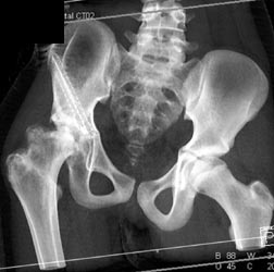 Chd With Osteotomy - CTisus CT Scan