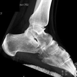 Medial Malleolus Fracture - CTisus CT Scan