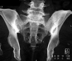 Hyperparathyoidism - CTisus CT Scan