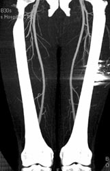 Ct Angiogram of the Thigh - CTisus CT Scan