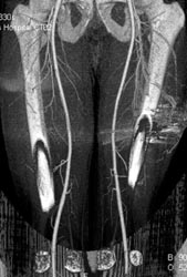 Ct Angiogram Post Gunshot to Thigh - CTisus CT Scan