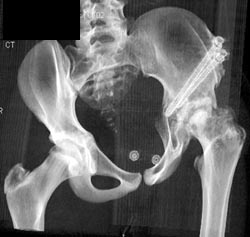 Osteotomy to Repair Dysplastic Hip - CTisus CT Scan