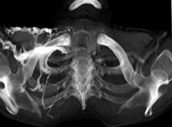 Osteomyelitis Head of Left Clavicle - CTisus CT Scan