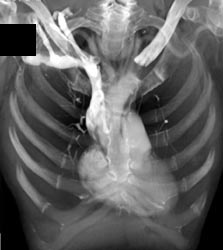 Erosion of Head of Left Clavicle - CTisus CT Scan