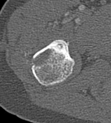 Osteoid Osteoma - CTisus CT Scan