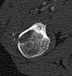 Osteiod Osteoma With Prior Failed Biopsy - CTisus CT Scan