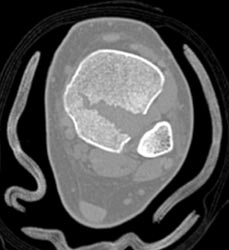 Tibial Fracture Through the Epiphyses - CTisus CT Scan