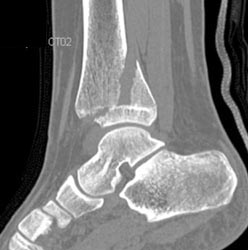 Fracture Line Through the Epiphyseal Plate - CTisus CT Scan