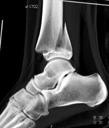 3D of Fracture Through Epiphyseal Plate - CTisus CT Scan