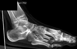 Tarsal Coalition - CTisus CT Scan