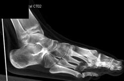 Tarsal Coalition - CTisus CT Scan