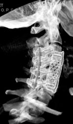 Fusion of C-spine With Graft - CTisus CT Scan