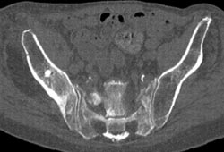 Sacral Insufficiency Fracture - CTisus CT Scan