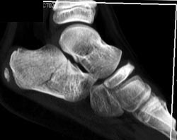 Calcaneal Fracture - CTisus CT Scan