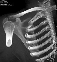 Trauma S/c Joint - CTisus CT Scan