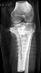 Repair of Tibial Fracture - CTisus CT Scan