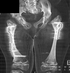 Osteotomy for Dysplastic Hips - CTisus CT Scan