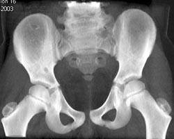 Benign Lesion in Iliac Bone - CTisus CT Scan