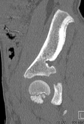 Benign Cartilage Defect - CTisus CT Scan