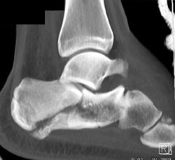 Calcaneal Fracture - CTisus CT Scan