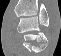 Calcaneal Fracture - CTisus CT Scan