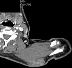 Malignant fibrous histiocytoma (MFH) of Shoulder - CTisus CT Scan